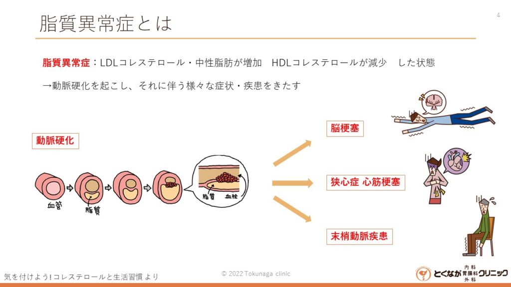 脂質異常症 のイメージ座豪